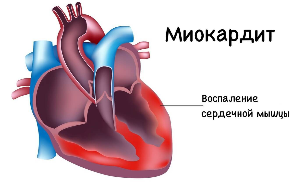 Миокардит: причины, осложнения и способы лечения | Медицинский центр Е.В.  Малышевой | Дзен