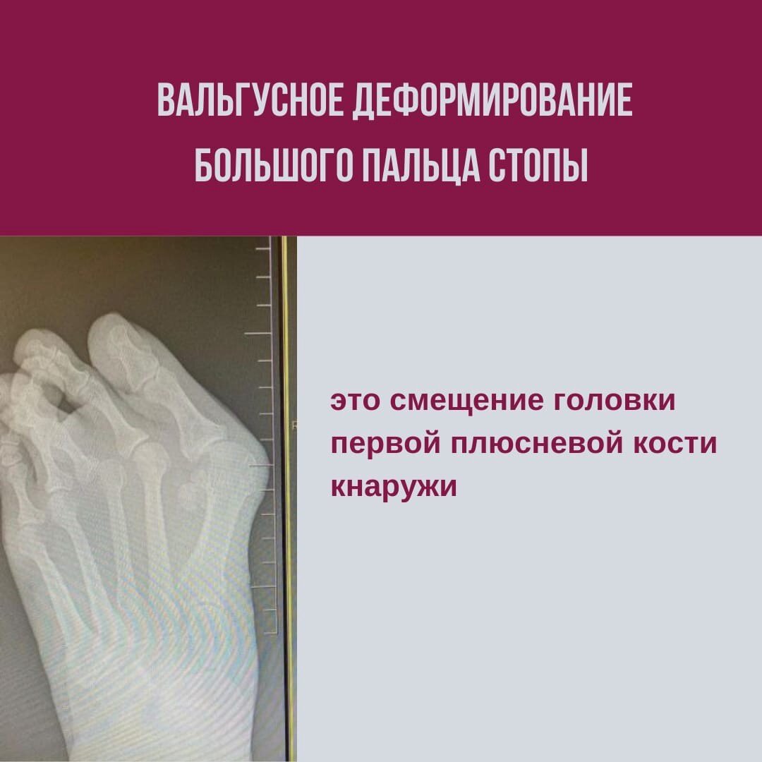 Вальгусное деформирование большого пальца стопы - это смещение головки первой плюсневой кости кнаружи.