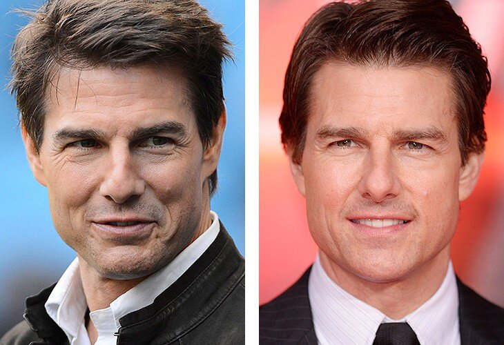 Том Круз до и после блефаропластики. Имеются противопоказания, необходима консультация специалиста. Foto by AbobeStock
