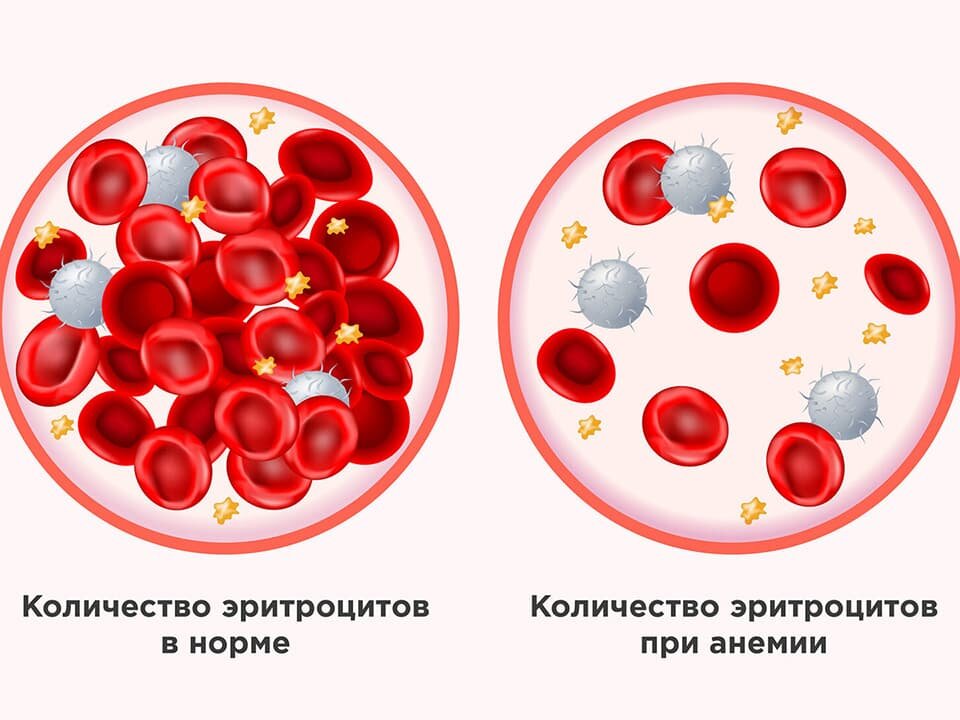 У женщин повышен гемоглобин в крови: причины и возможные последствия