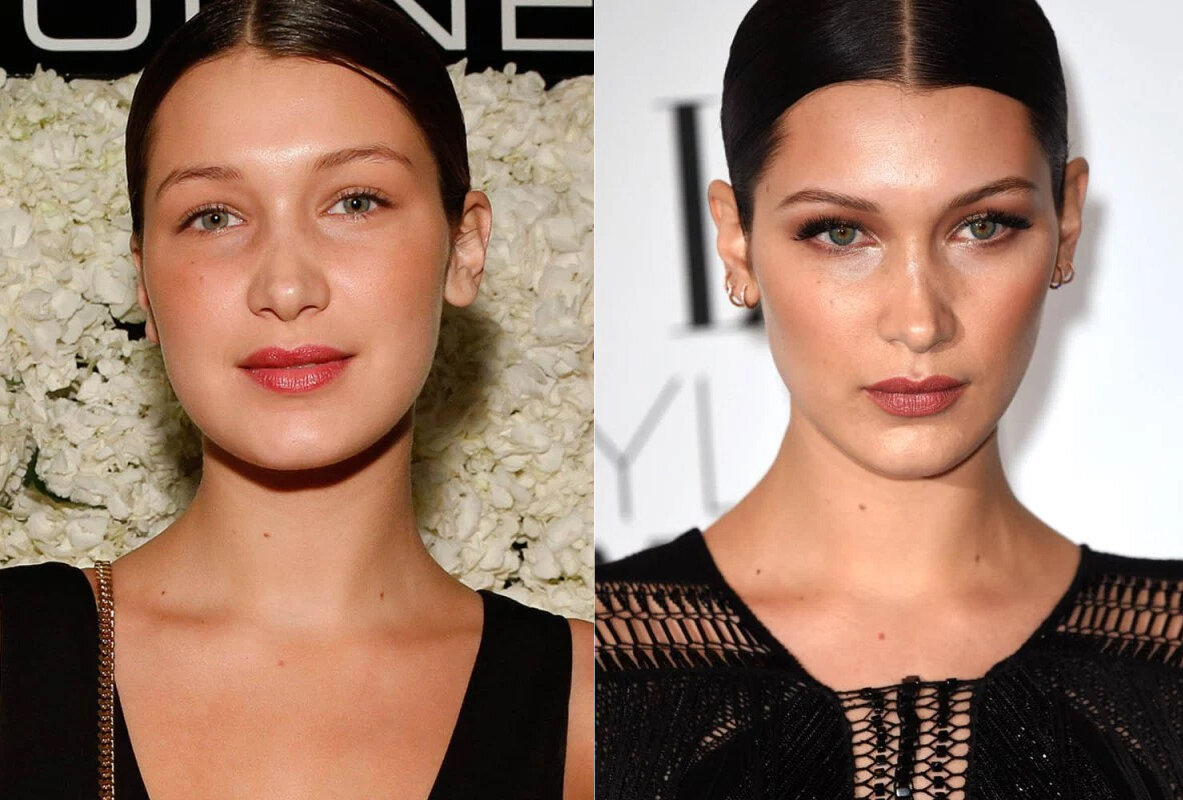 Бэла Хадид  до и после удаления комков Биша