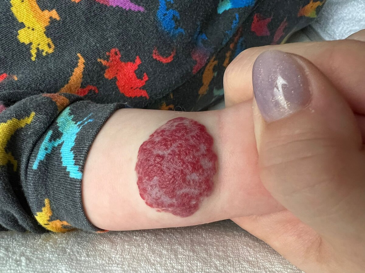 Младенческая гемангиома в области правого предплечья. (клинический материал "Центра сосудистой патологии") 