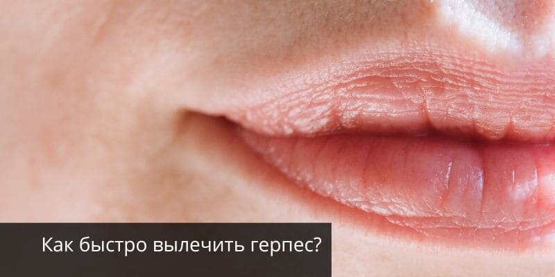 Как быстро вылечить герпес