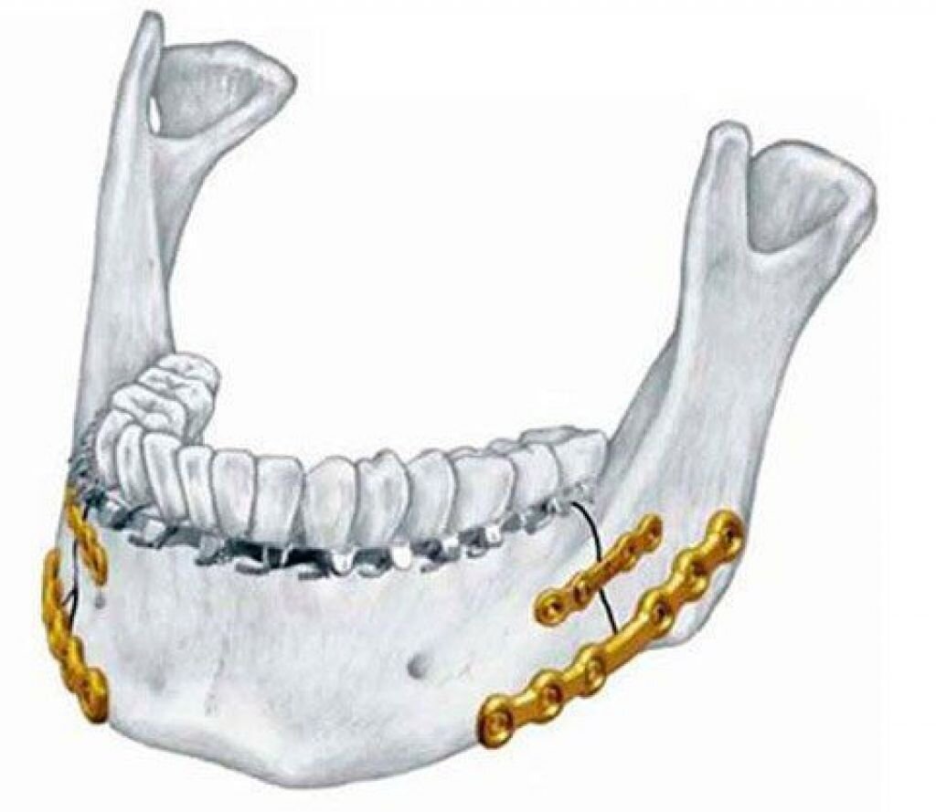 Хирургический лечение перелома нижней челюсти. Остеосинтез при переломе нижней челюсти. Остеосинтез челюсти при переломе нижней челюсти. Шинирование челюсти при переломе нижней челюсти. Перелом челюсти шинирование.
