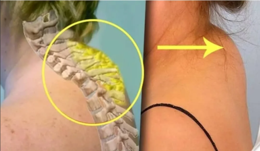 По статистике 2 из 5 человек старше 55 лет страдают от холки сзади шеи. Как убрать с помощью упражнений