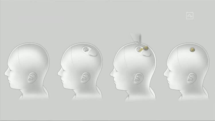 Презентация Нейролинк