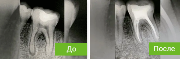 Успешное лечение корневых каналов
