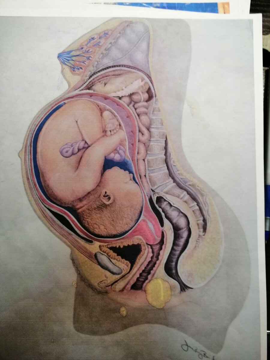 ШМ длинная. Ниже головки ребенка (темный треугольник)- мочевой пузырь. Дно матки- под рёберными дугами.