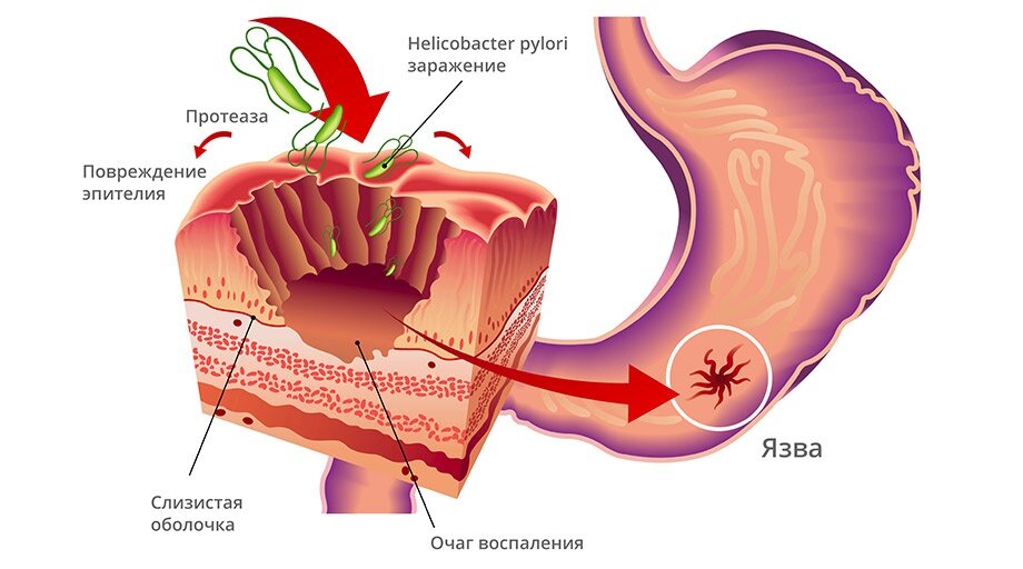 Helicobacter Pylori - основаня причина возникновения язвы желудка. Ссылка на источник изображения: https://clck.ru/32VWCg