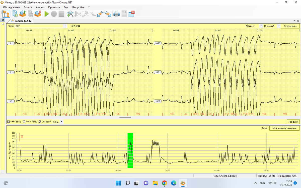 Вот такая "красота"(((( Понятное дело, это не вся. Вот те всплески высокие, как по одному, так и много подряд - это и есть наша проблема. Те, которых много, особенно опасны., 