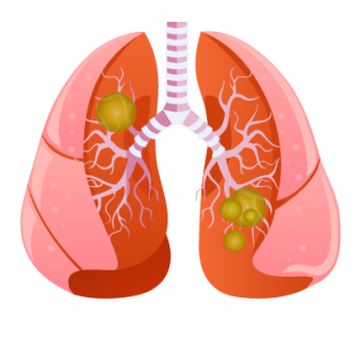Источник фото: https://www.smclinic.ru/diseases/pnevmoniya/