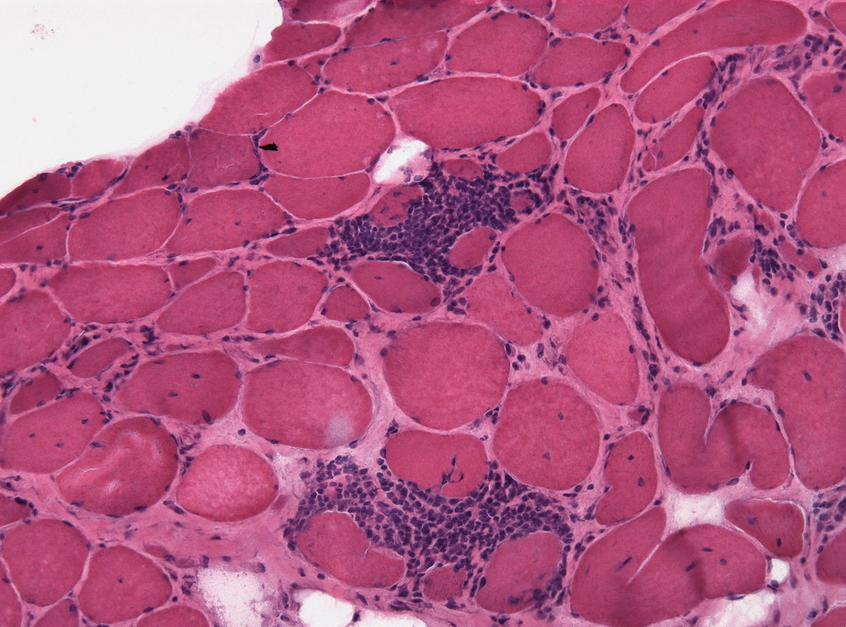 Polimiozita pe histologie