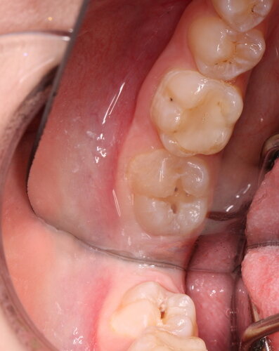 Зубы зрелого человека 35+