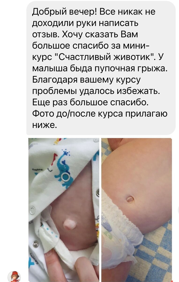 Госпитализация при пупочной грыже