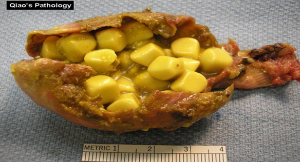 Холестериновые камни в желчном пузыре: печень секретирует в желчь много синтезированного ею холестерина