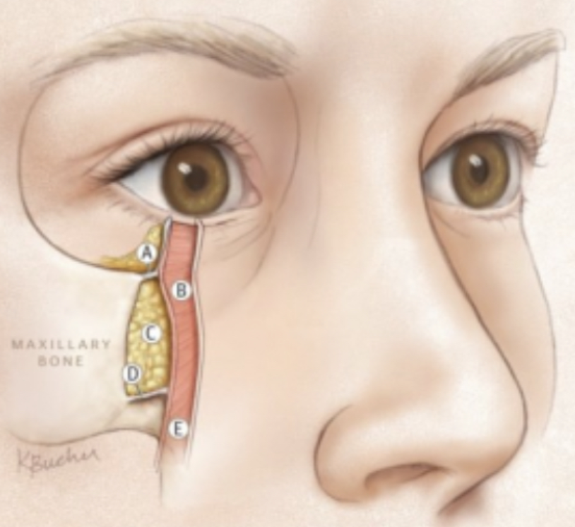 Анатомия подглазничной зоны: A, C, D – жировые пакеты, B – круговая мышца глаза 