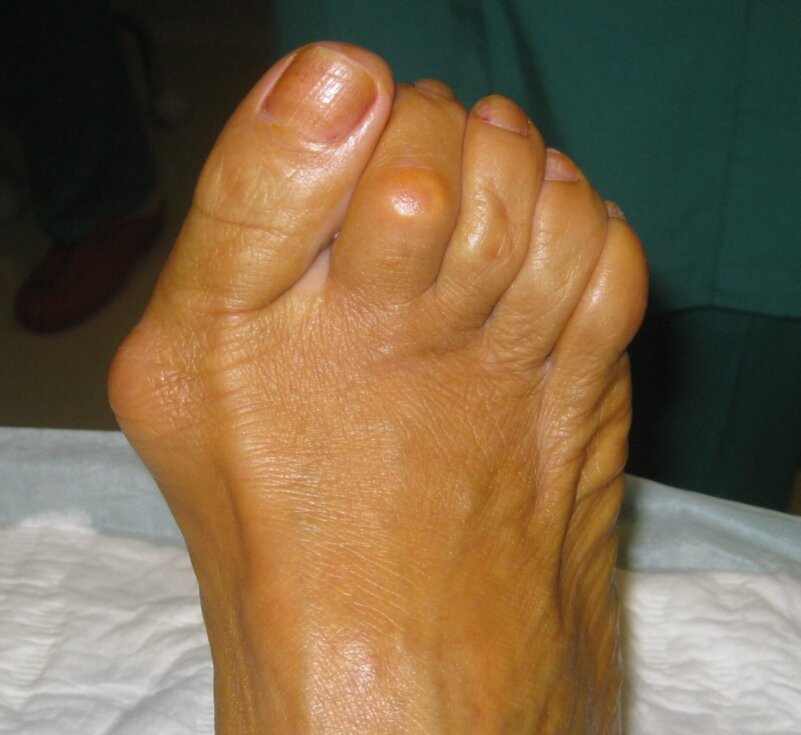 Ну да, шишка есть. Но что на самом деле там, под кожей?