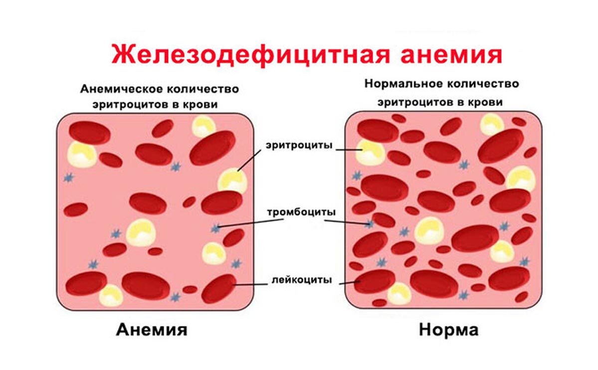 Железодефицитная анемия: причины, симптомы, лечение