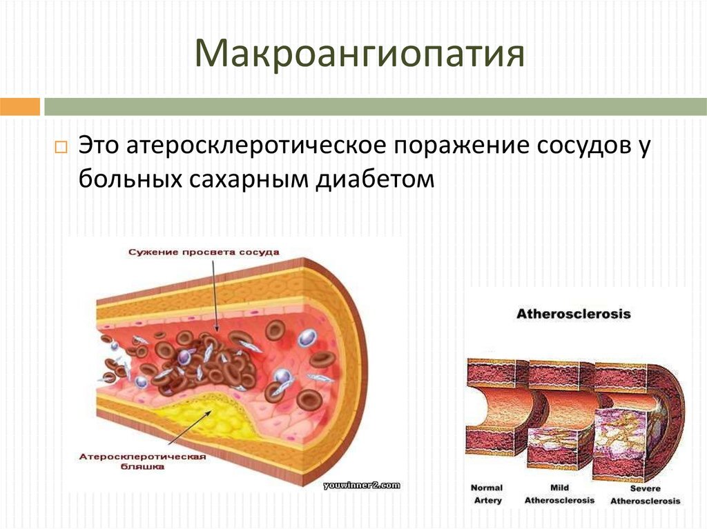 Поражение сосудов у больных диабетом при макроангиопатии