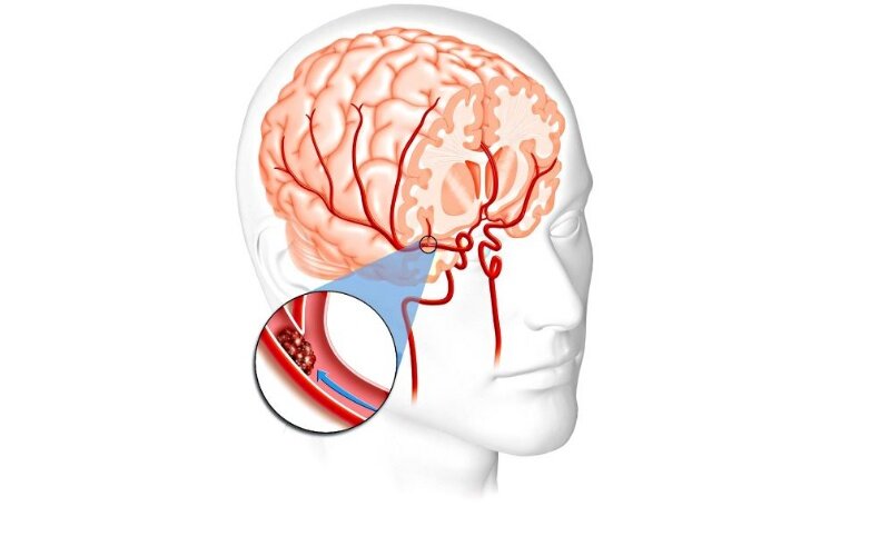 Сосудистые заболевания мозга - о чем нужно знать каждому