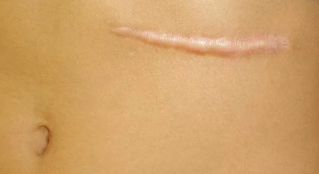 Гипертрофический рубец 