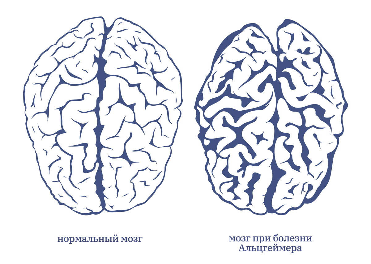 Мозг от матки до альцгеймера. Альцгеймера. Альцгеймер человек имя. Тест на риск Альцгеймера рисунок верблюд.