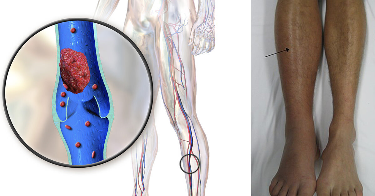 Тромбоз глубоких вен голени фото