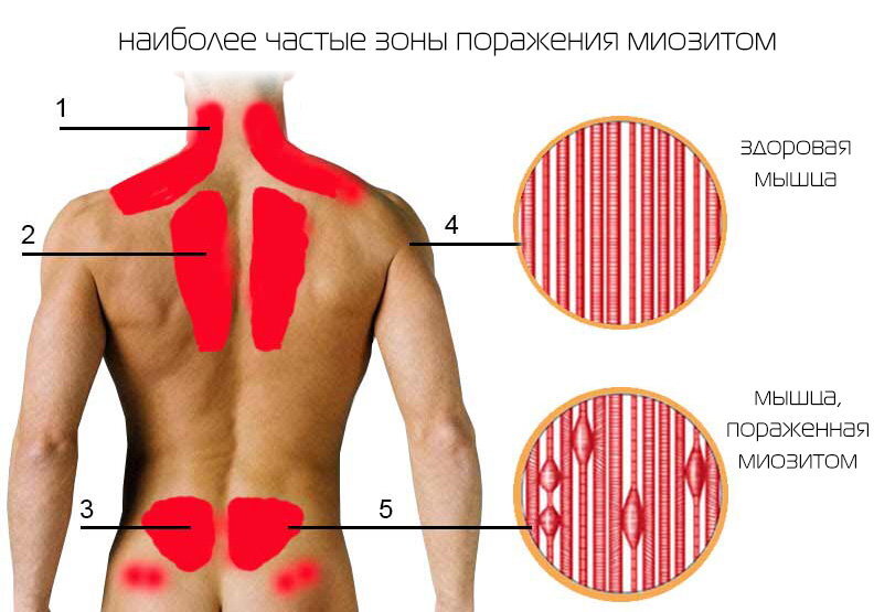 Как отличить ГРИПП от простуды