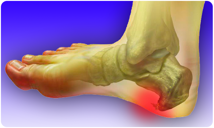 Почему болит подъём стопы при ходьбе и во время бега, причины сильной боли в ноге, что делать
