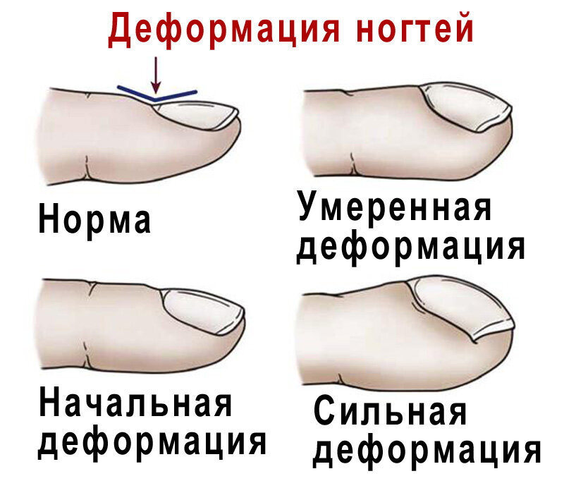 Степени деформации ногтей