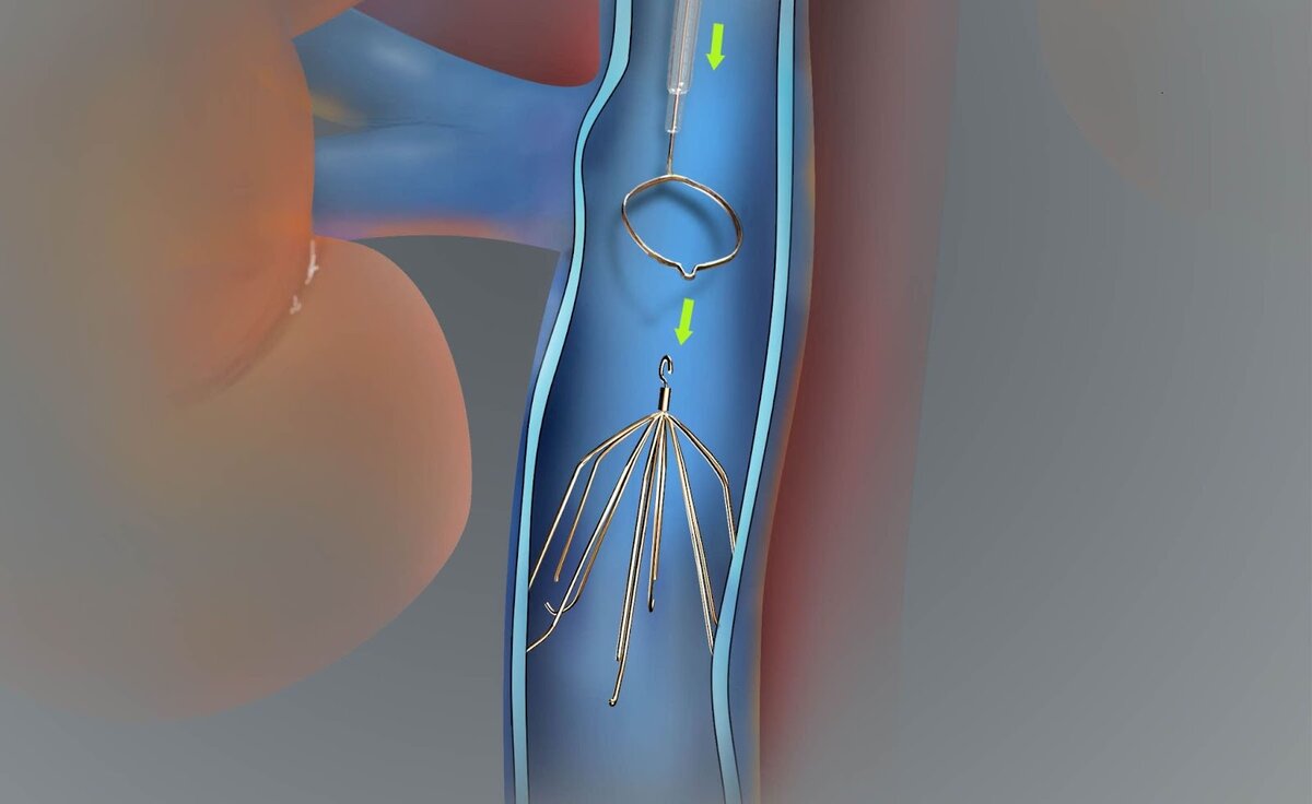 Тромбоз артерии операция. Эндоваскулярная тромбэктомия аспирационная что это. Кава фильтр в нижней полой Вене. Эндоваскулярная тромбэкстракция. Чрескожная аспирационная тромбэктомия.