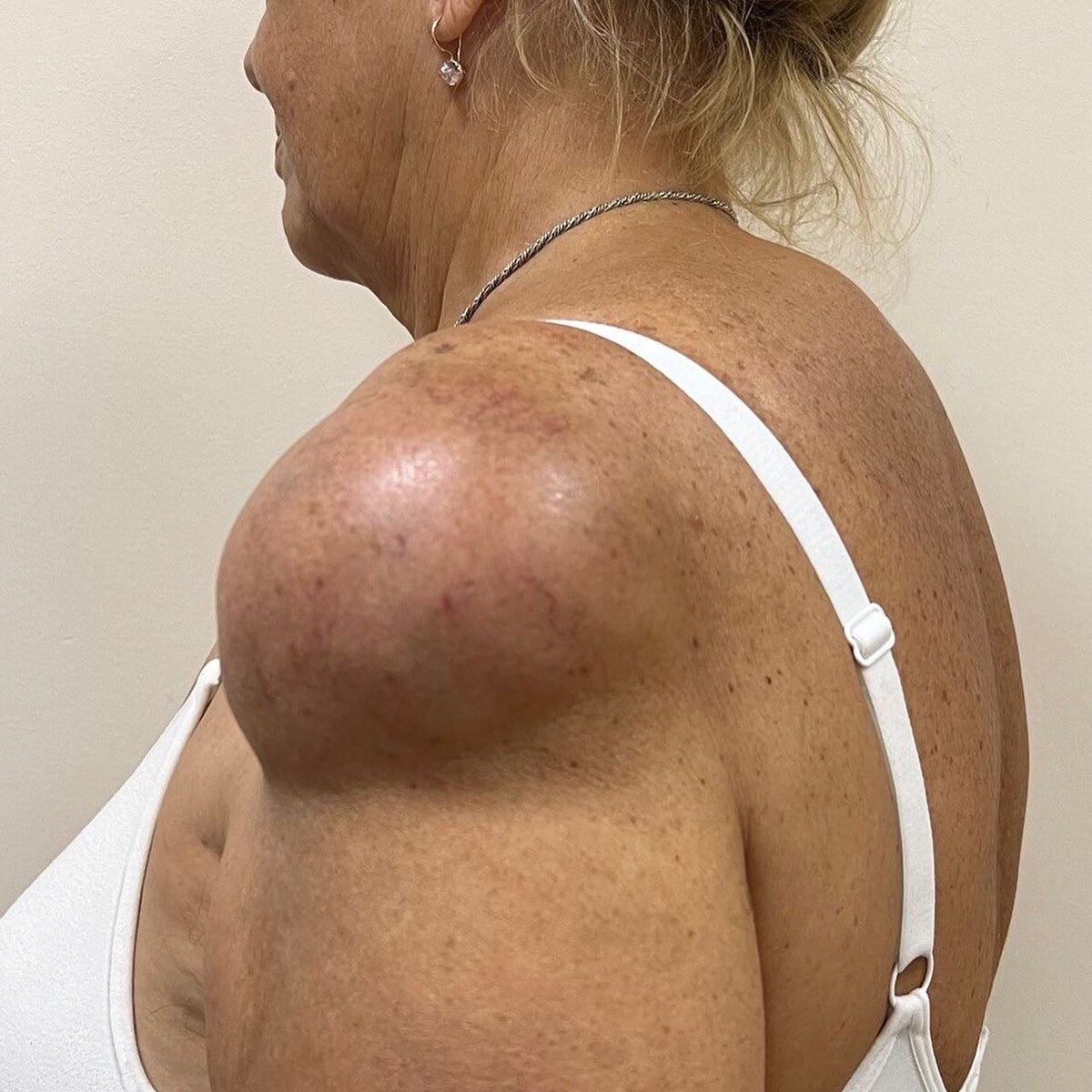 Липома в области плеча у женщины 60-ти лет