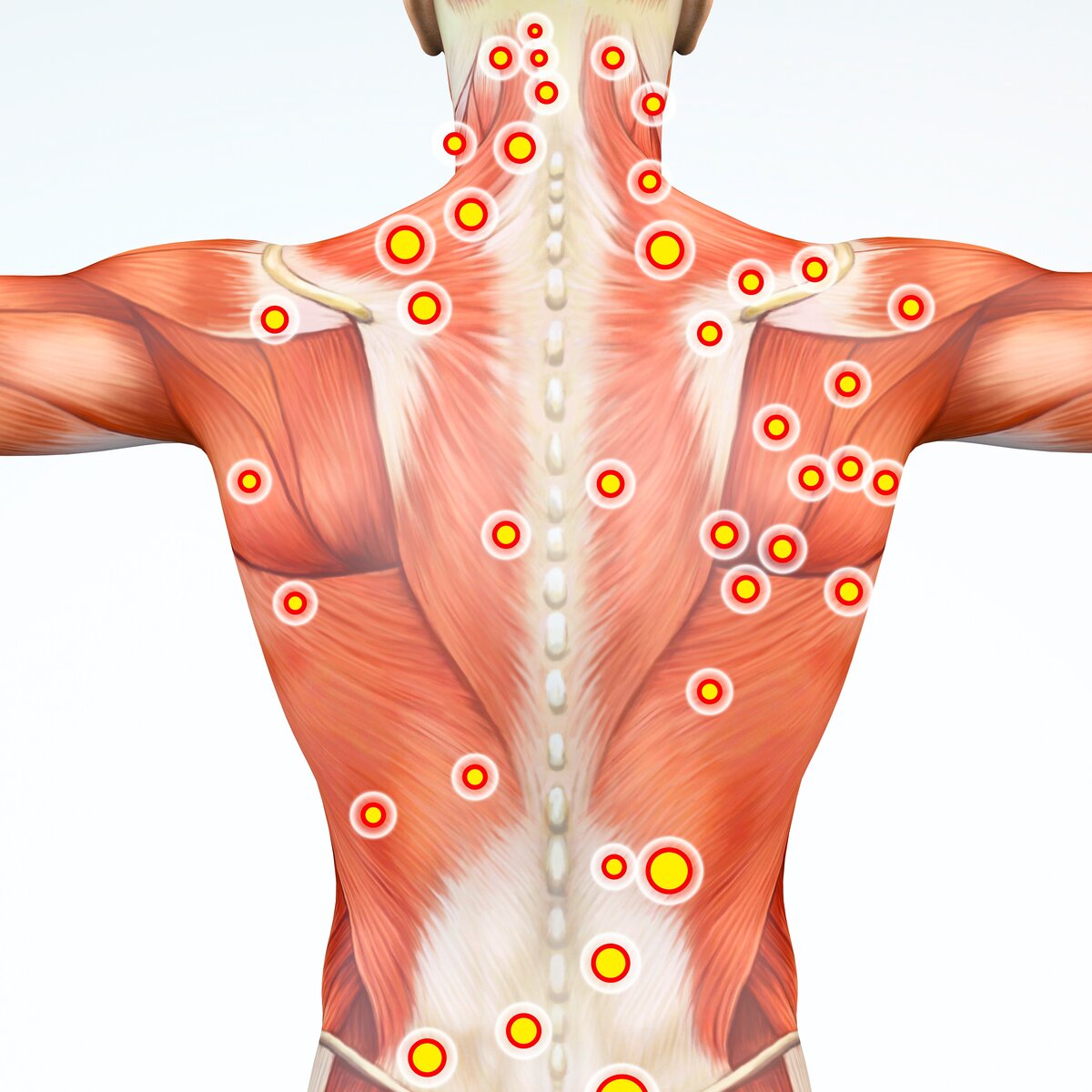 Триггерная точка в мышцах