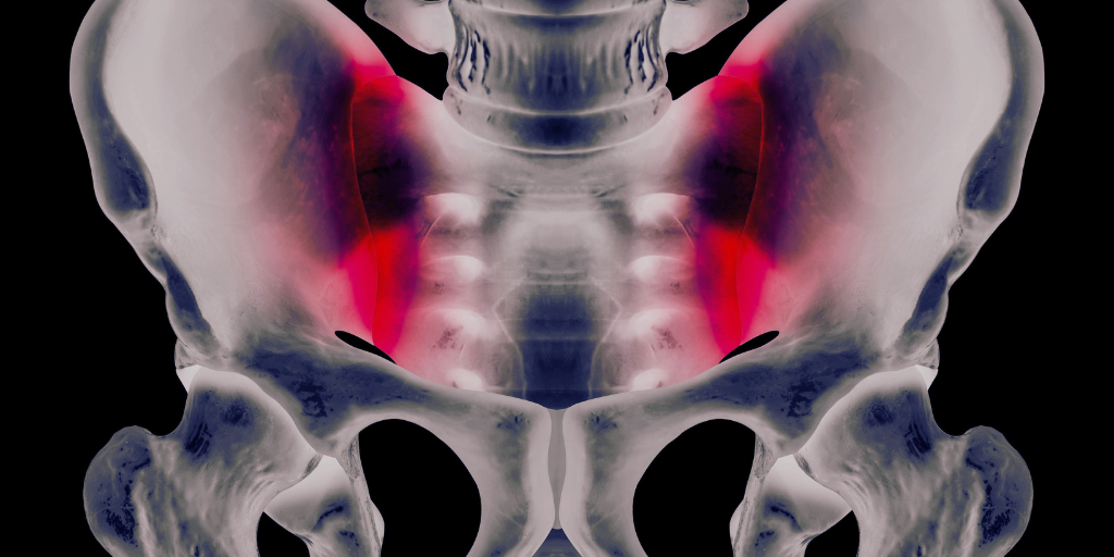 Воспаление крестцово -подвздошных суставов.