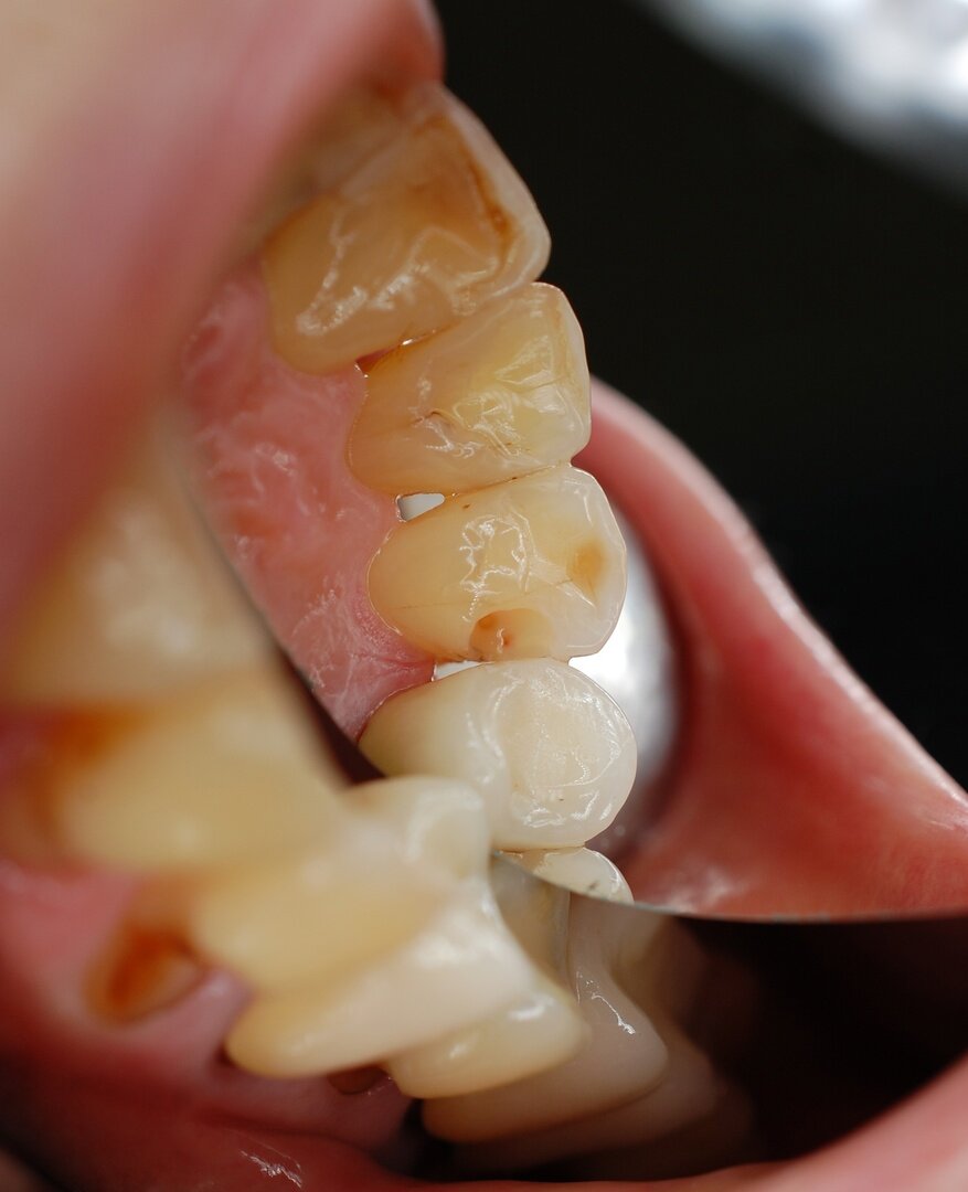 состояние зуба 1.3 после удаления старой пломбы и видимого кариозного процесса 