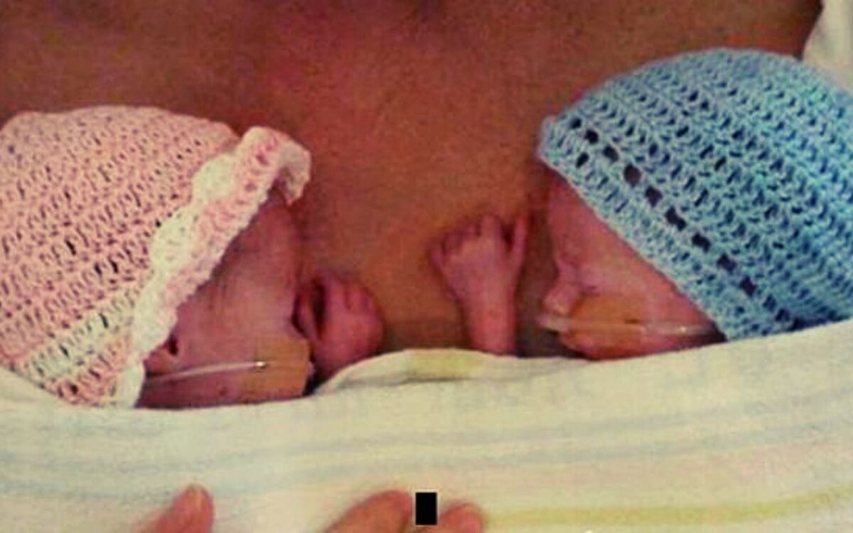 Близнецы девочка Эмили и мальчик Джейми вскоре после рождения