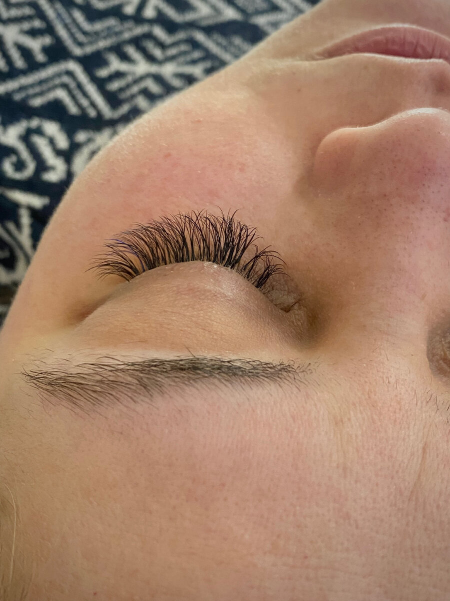 Фото ДО. Носка 8 недель, объем 3D.