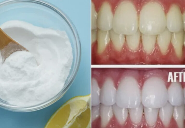 Эффективное отбеливание в домашних условиях. Отбеливание зубов содой. Домашнее отбеливание зубов. Отбеливание зубов перекисью водорода.