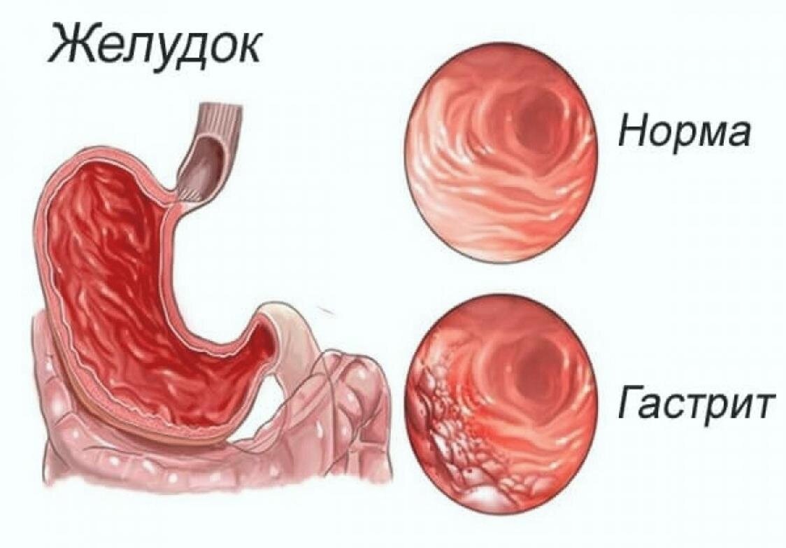 Лечение гастрита