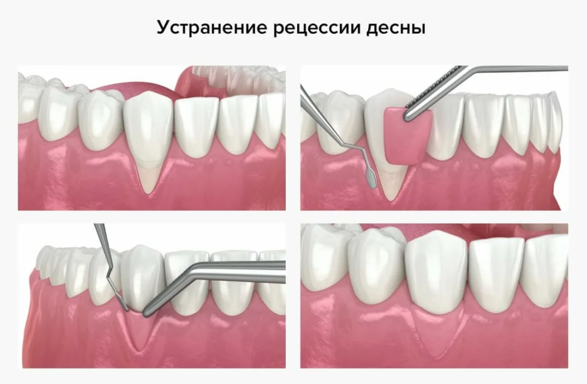 Исправляем форму десен. Гингивопластика. Рецессия десен. Остеопластика пародонтит. Пластика рецессии десен.