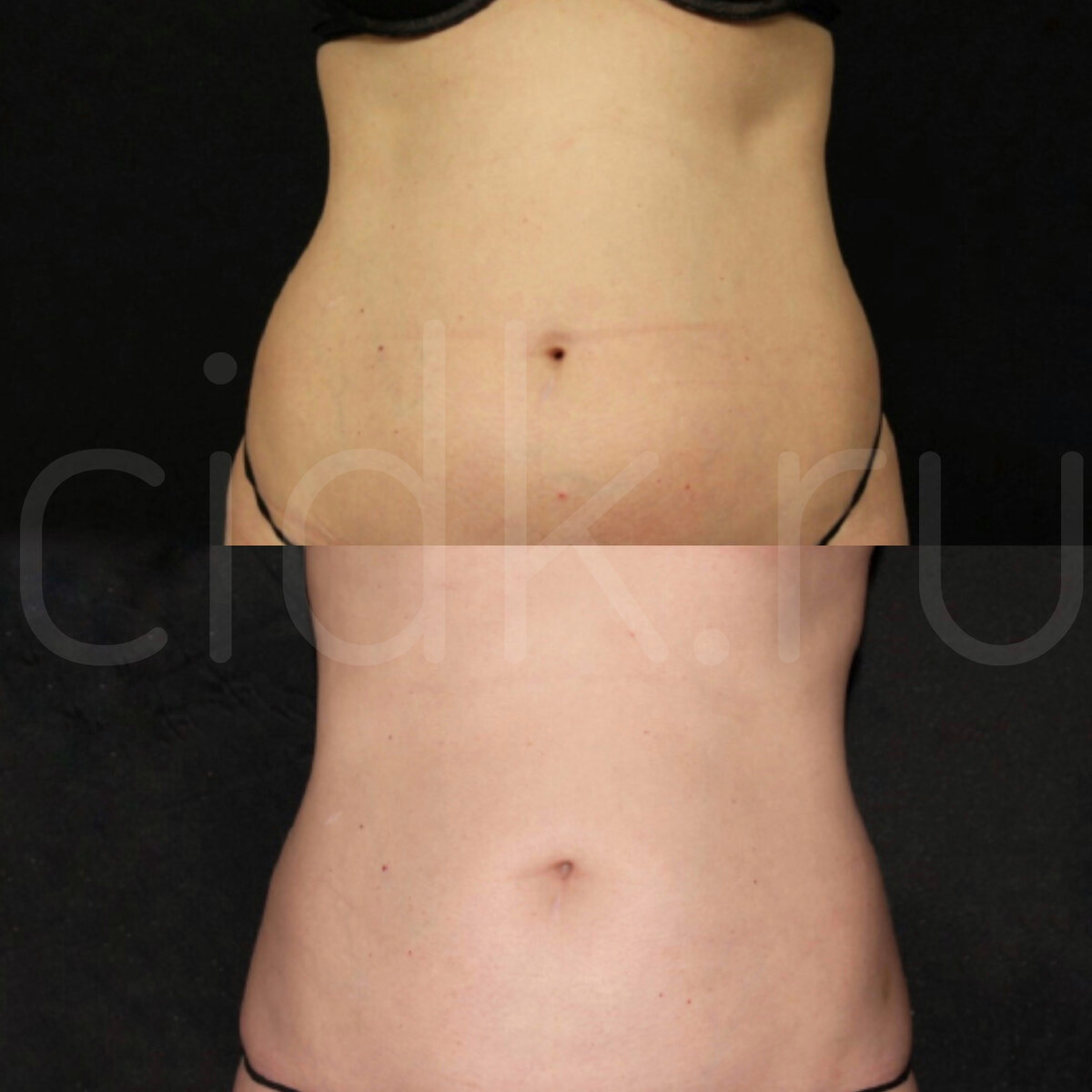 КАК УБРАТЬ ЖИР С ЖИВОТА ДО И ПОСЛЕ