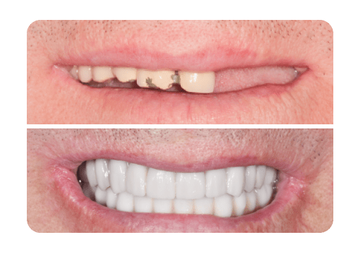 Особенности несъемных зубных протезов | Стоматология Фамилия в ...