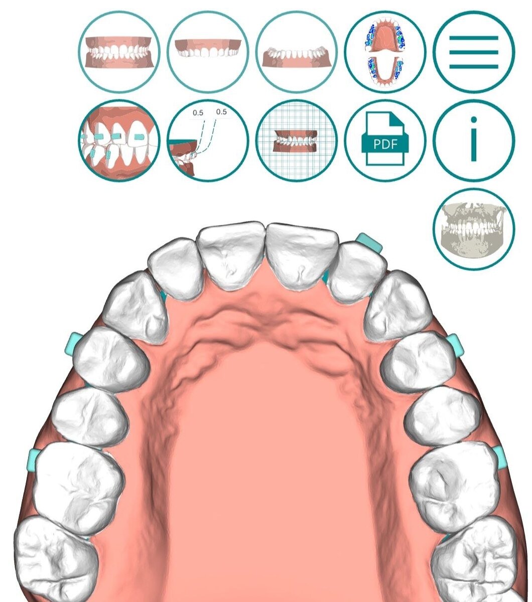 фрагмент компьютерного планирования выравнивания зубов капами 3DSmile