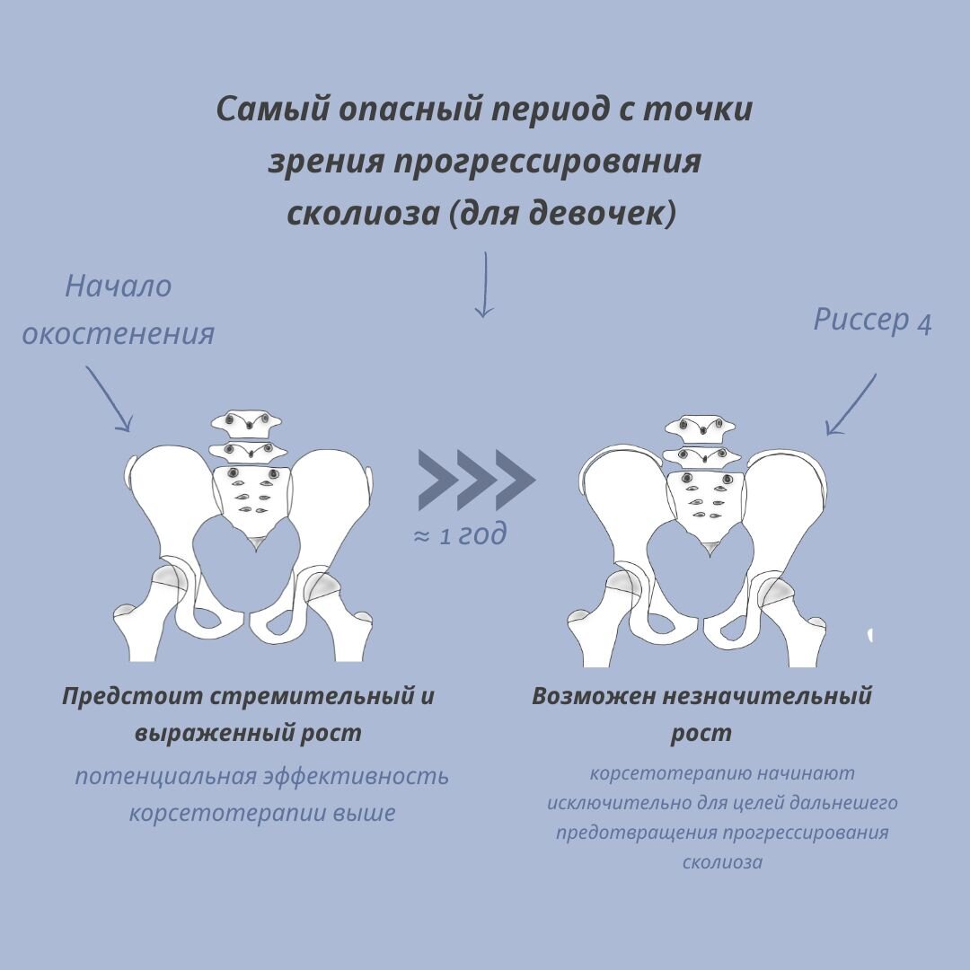 Степень Риссера. Практическая ценность | Сколио центр | Дзен