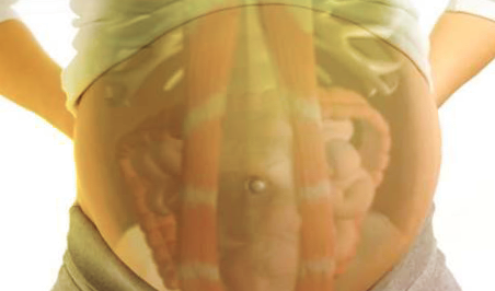 На фото хорошо видно, как прямые мышцы живота сдвинуты в стороны. Как раз между ними - растянутая белая линия или диастаз