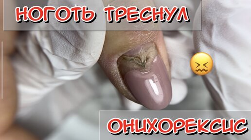 Ониходистрофия ногтей