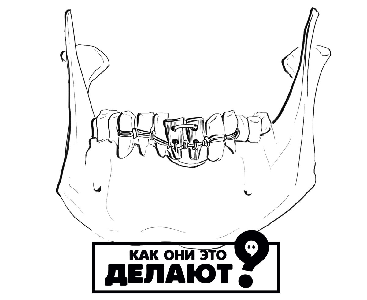 Крепление протезов проволокой