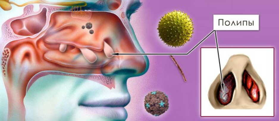 Доброкачественные опухоли полости носа: причины, симптомы и лечение