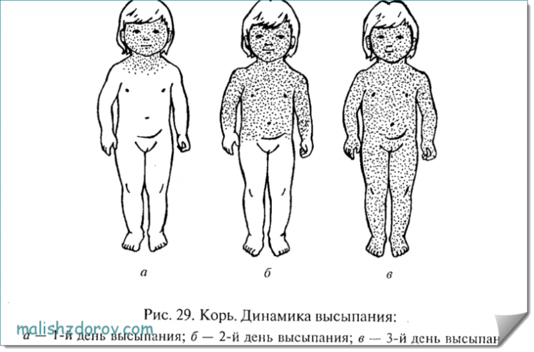 Сыпь у ребенка без температуры | Деловой Город | Дзен