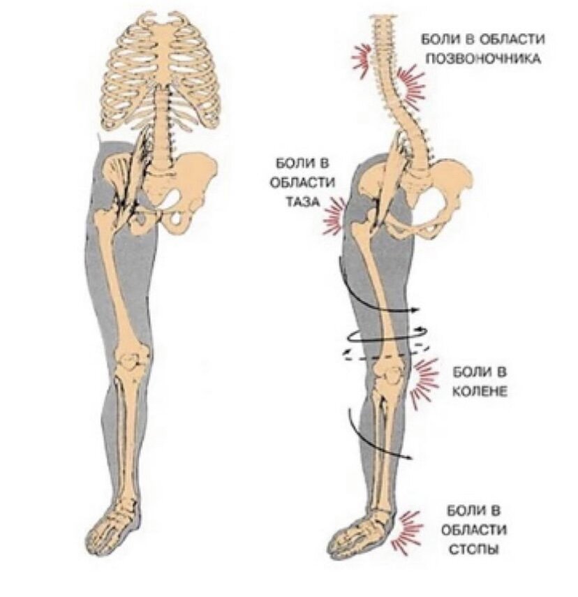 Слева - норма, справа - вальгусная деформация